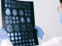 Alzheimer-Krankheit – was ist sie wirklich und kann sie geheilt werden?